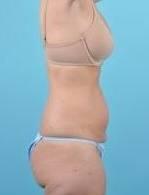 CoolSculpting Before & After Image