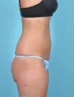 CoolSculpting Before & After Image Patient 23002