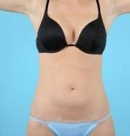 CoolSculpting Before & After Image