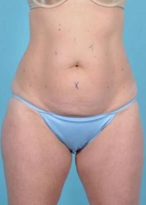 CoolSculpting Before & After Image Patient 23004