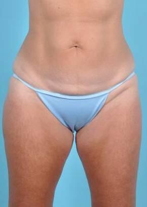 CoolSculpting Before & After Image