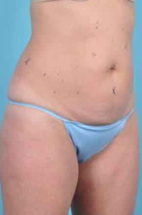 CoolSculpting Before & After Image