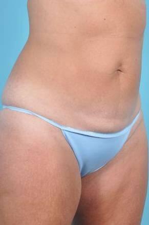 CoolSculpting Before & After Image