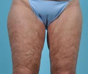 CoolSculpting Before & After Image