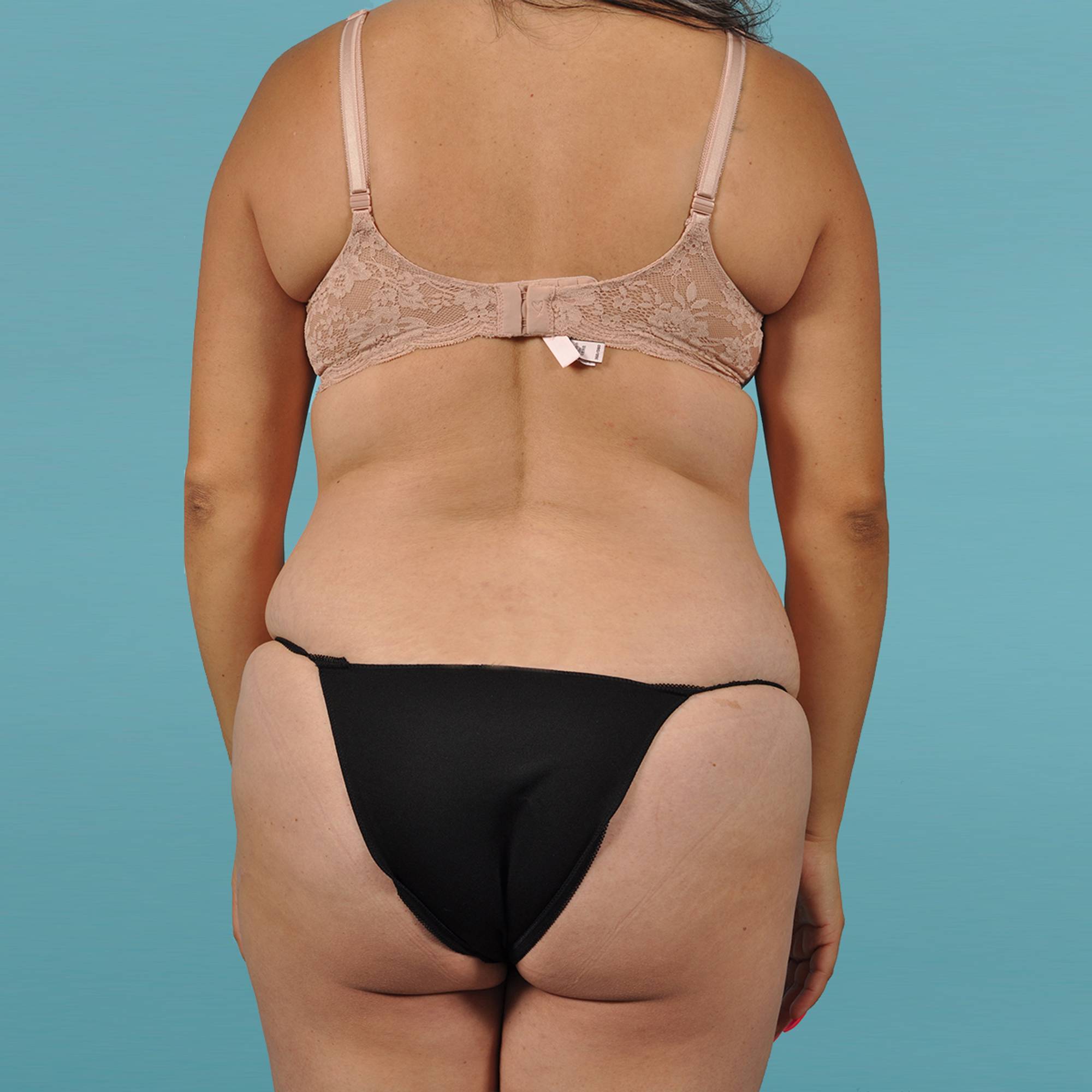 Fat Transfer Before & After Image