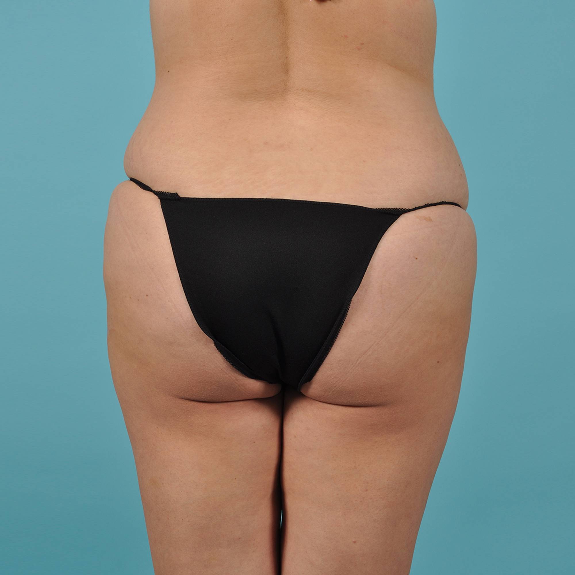 Fat Transfer Before & After Image