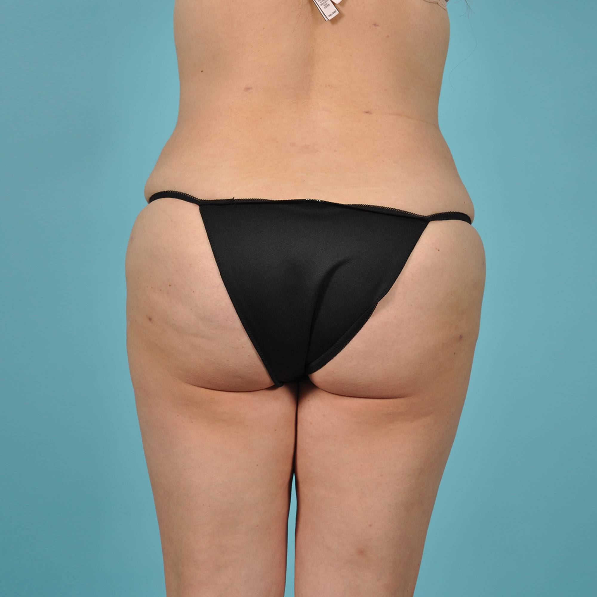 Fat Transfer Before & After Image