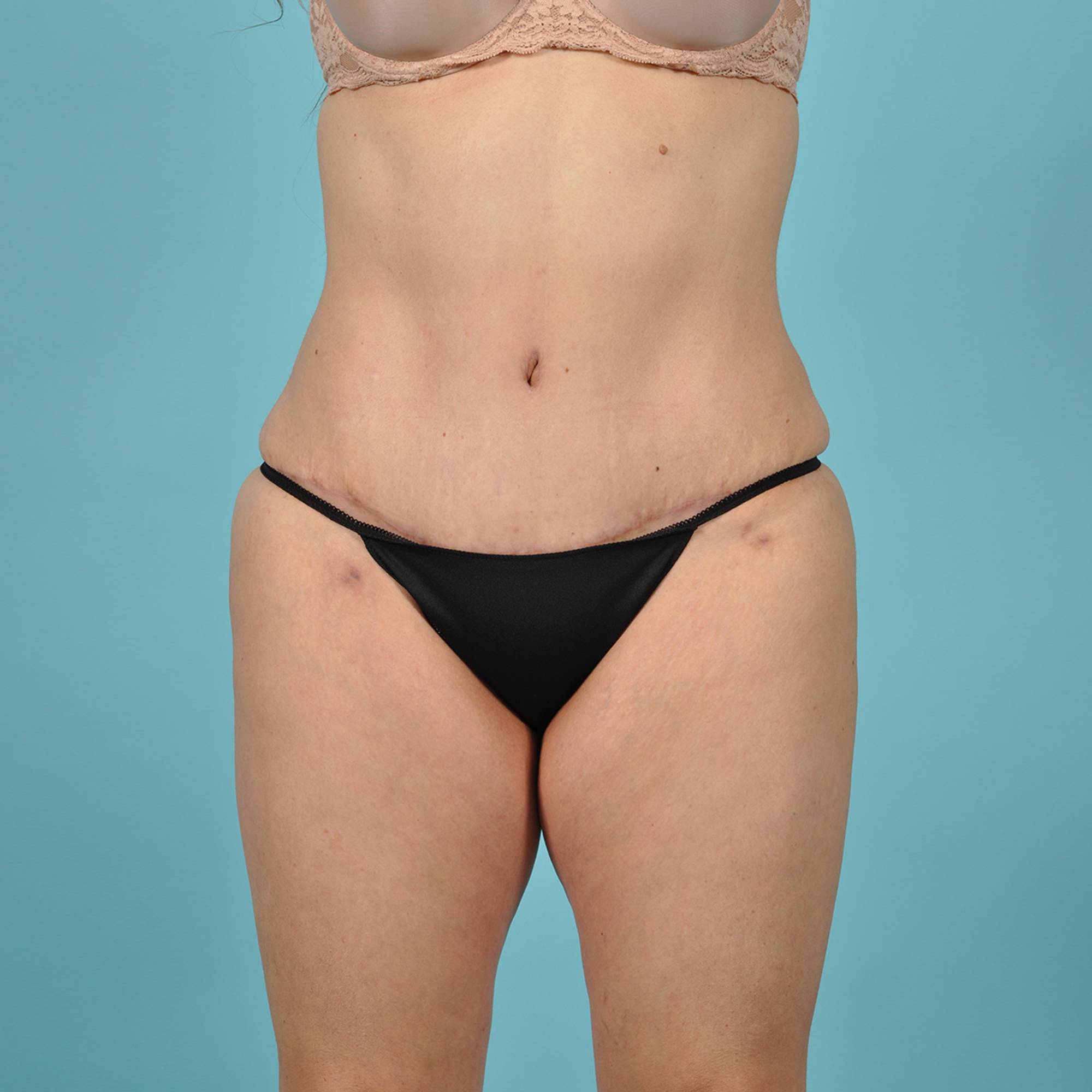 Fat Transfer Before & After Image