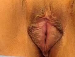 Labiaplasty Before & After Image Patient 24000
