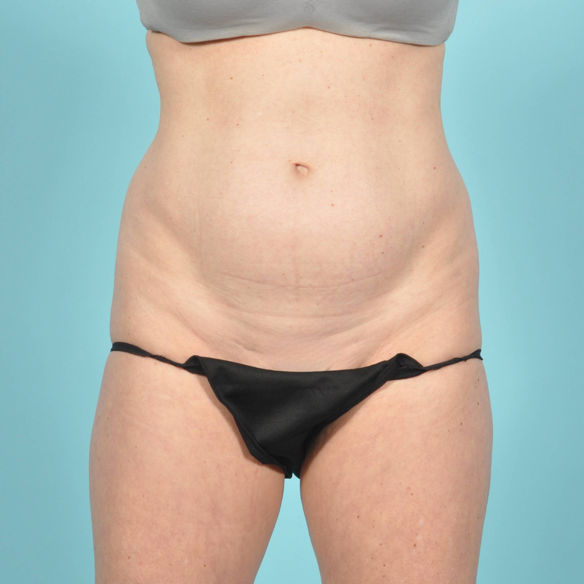  Before & After Image
