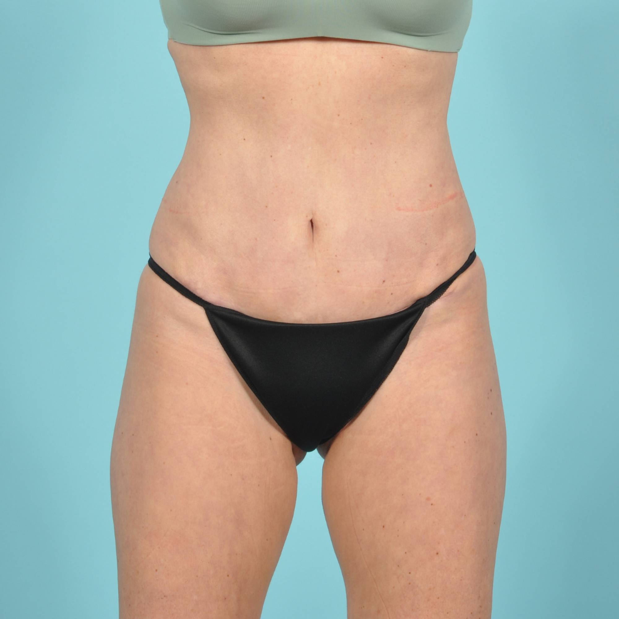  Before & After Image