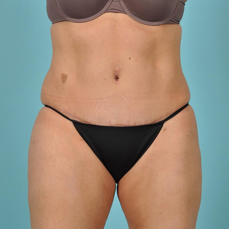 Liposuction Before & After Image