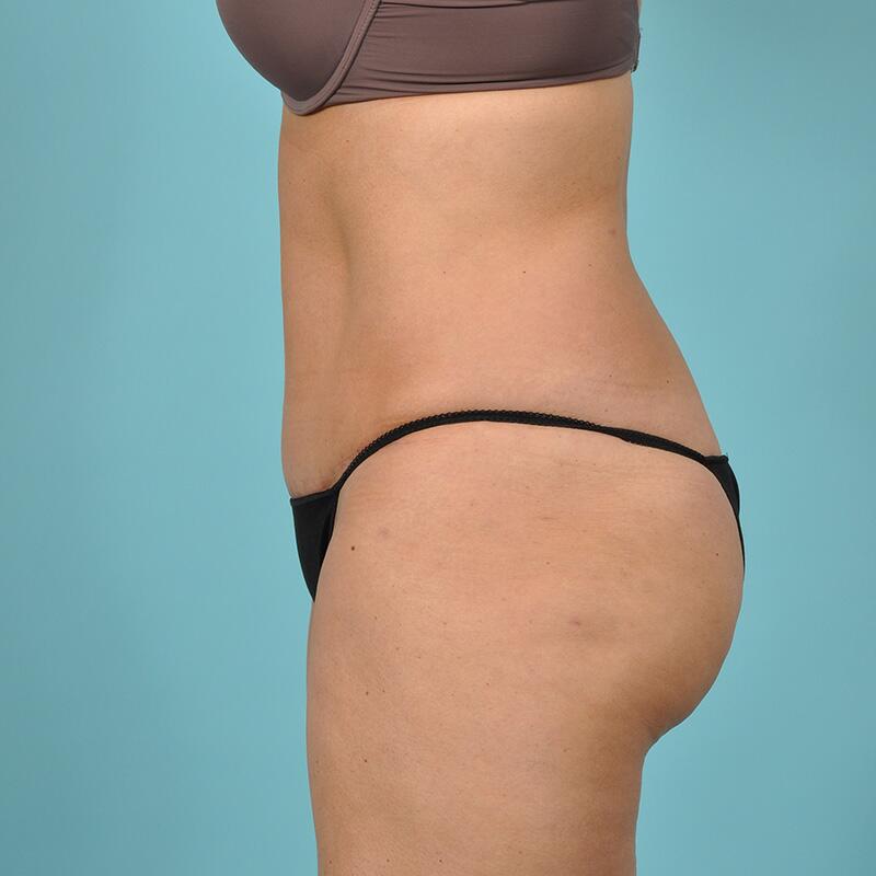 Liposuction Before & After Image