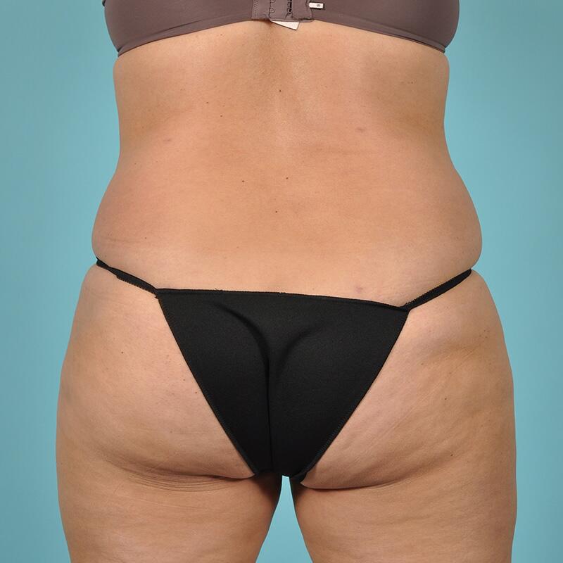 Liposuction Before & After Image