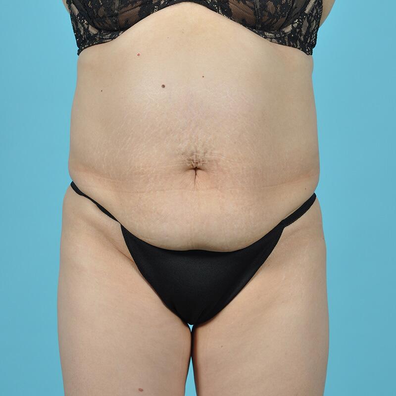 Liposuction Before & After Image