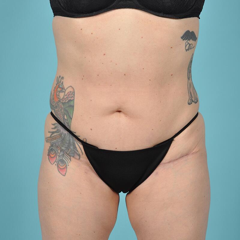 Liposuction Before & After Image