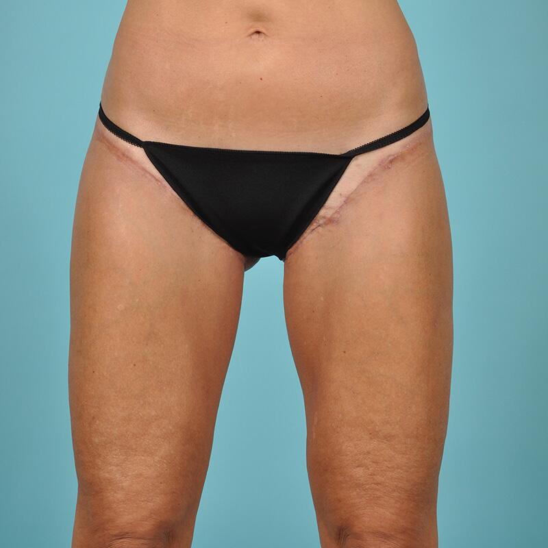 Liposuction Before & After Image Patient 27416