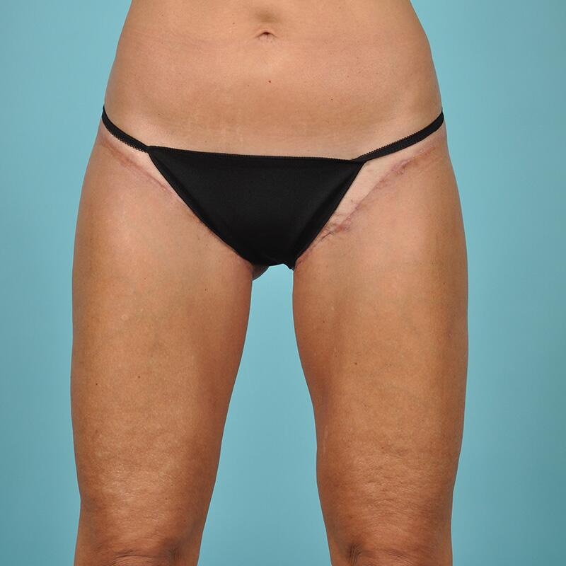 Liposuction Before & After Image