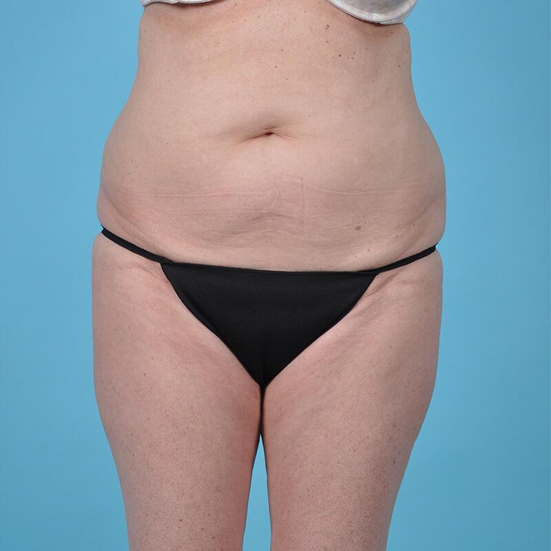 Liposuction Before & After Image