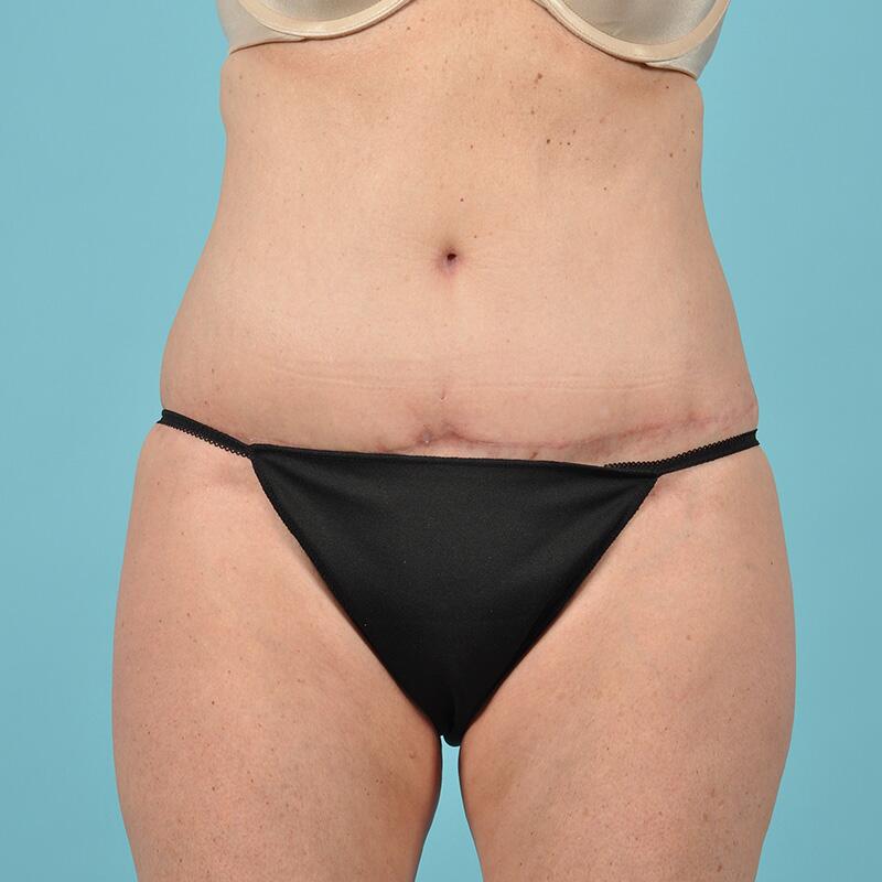 Liposuction Before & After Image