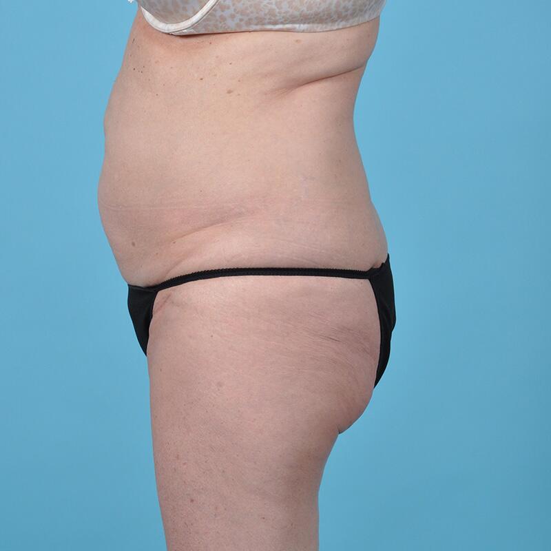 Liposuction Before & After Image