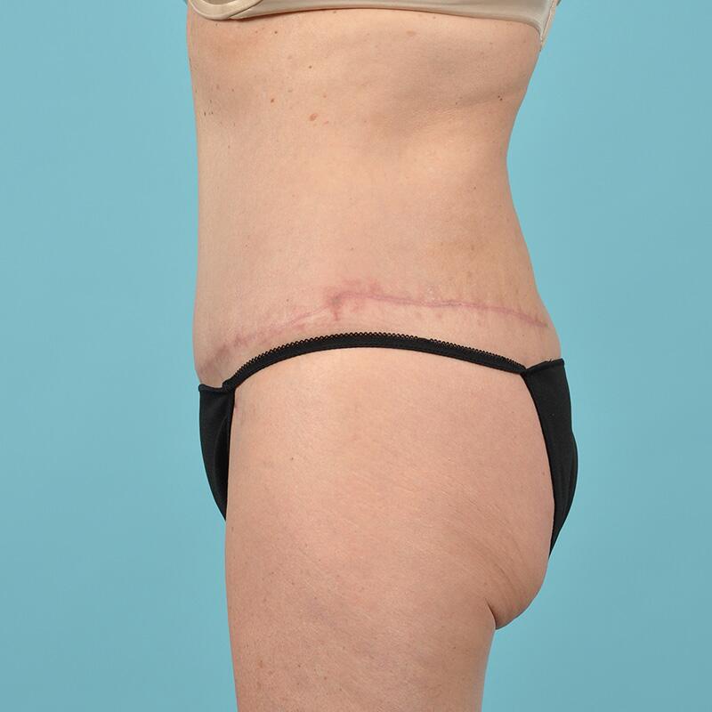 Liposuction Before & After Image