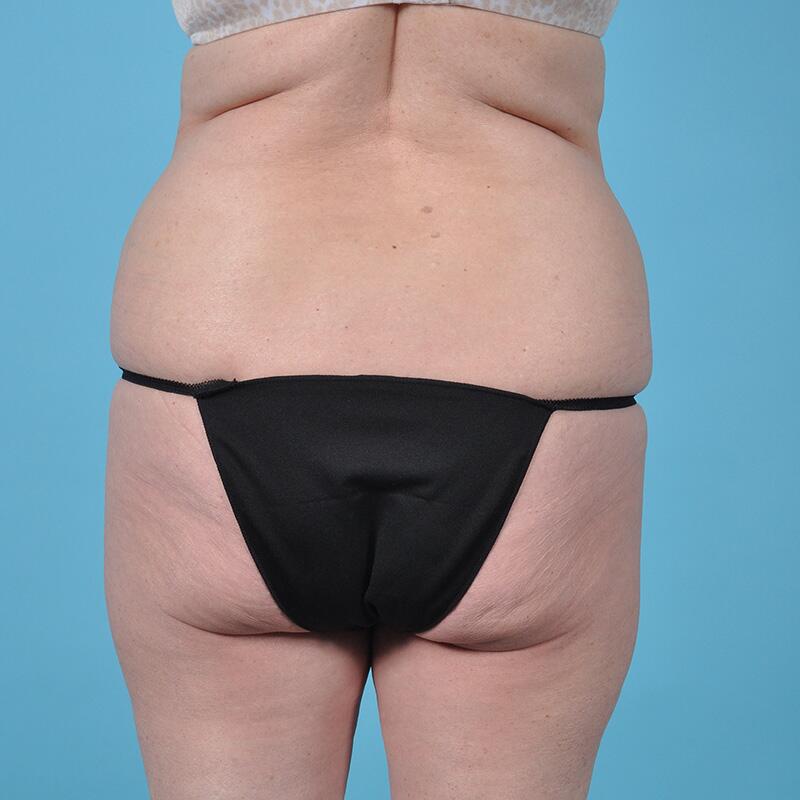 Liposuction Before & After Image