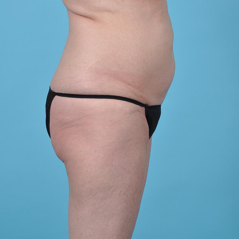 Liposuction Before & After Image Patient 27417