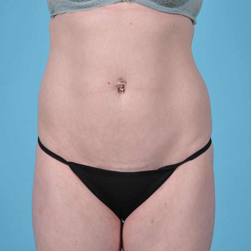 Liposuction Before & After Image