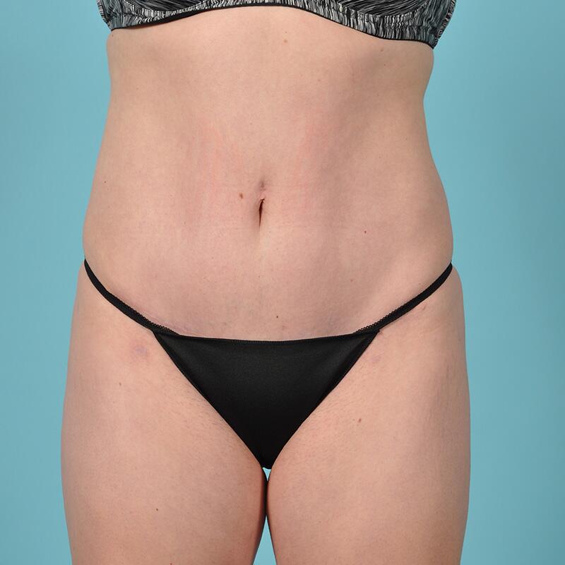 Liposuction Before & After Image Patient 27418