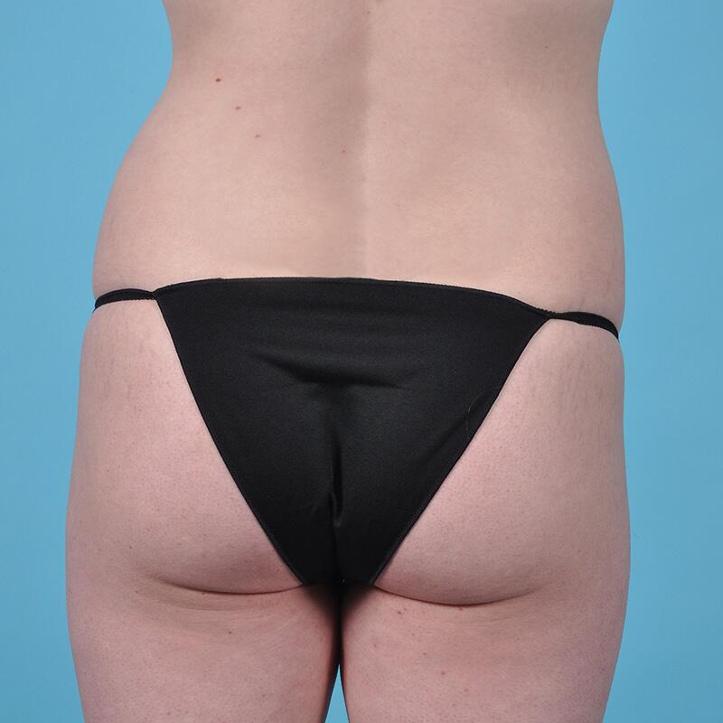 Liposuction Before & After Image Patient 27418