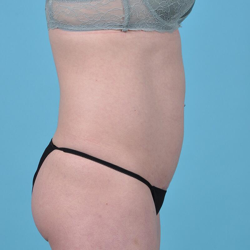 Liposuction Before & After Image Patient 27418