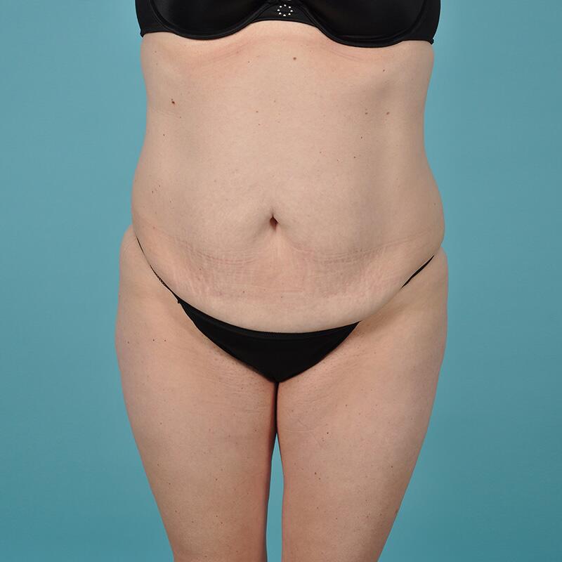 Liposuction Before & After Image Patient 27420