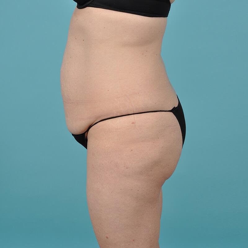 Liposuction Before & After Image