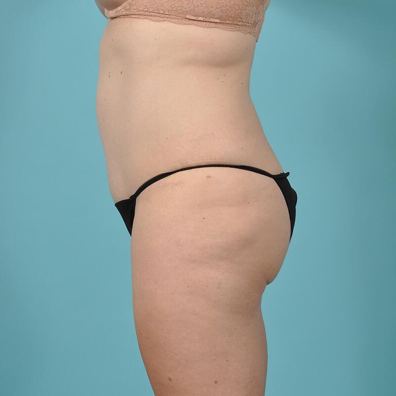 Liposuction Before & After Image