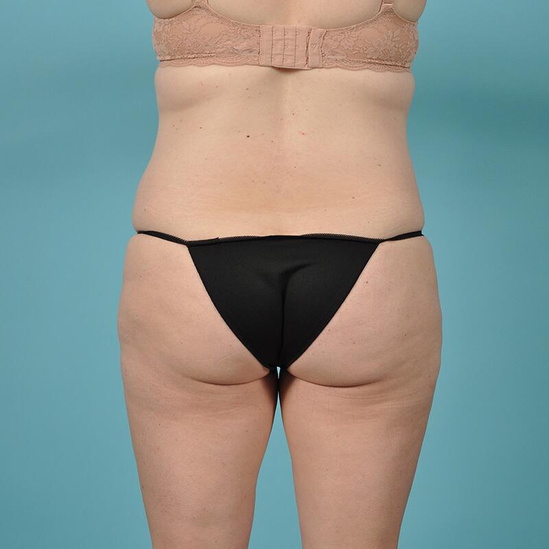 Liposuction Before & After Image Patient 27420