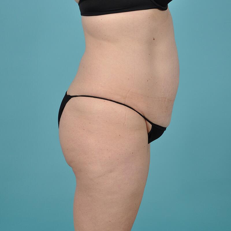 Liposuction Before & After Image Patient 27420