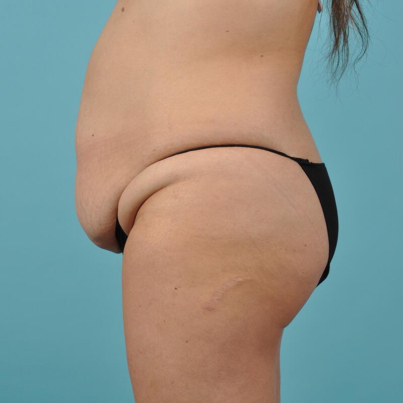 Liposuction Before & After Image