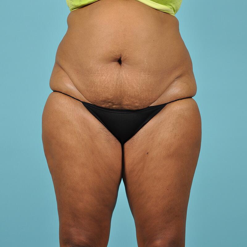 Liposuction Before & After Image