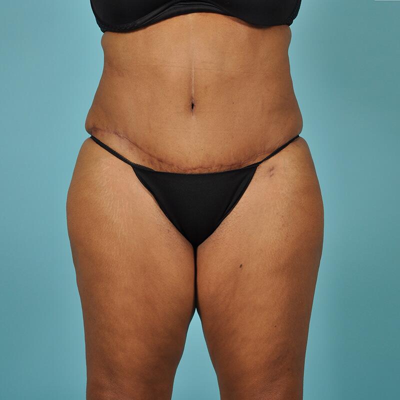 Liposuction Before & After Image