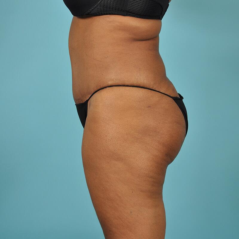 Liposuction Before & After Image Patient 27422