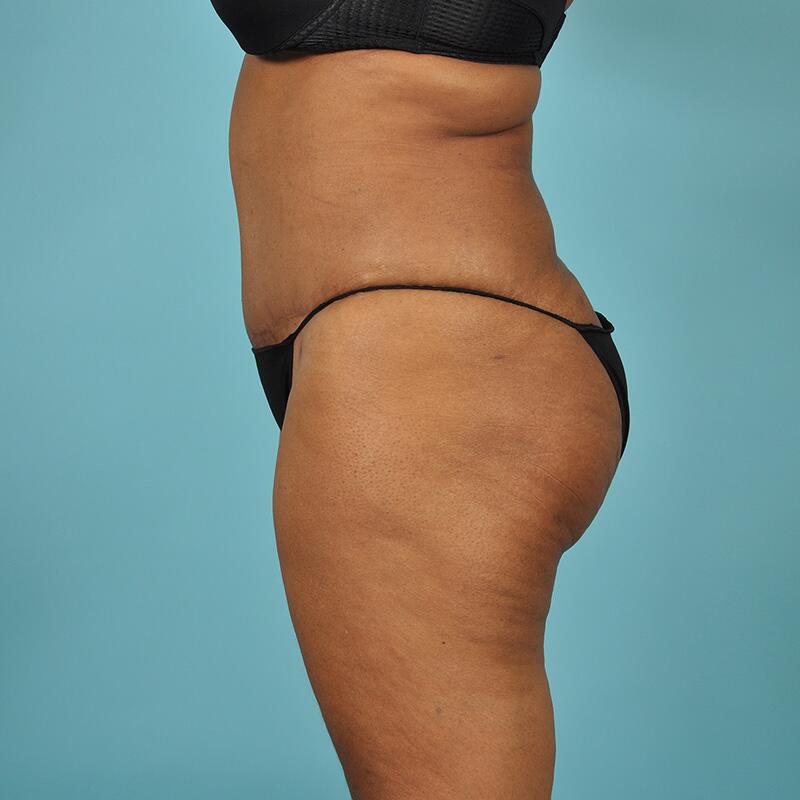 Liposuction Before & After Image