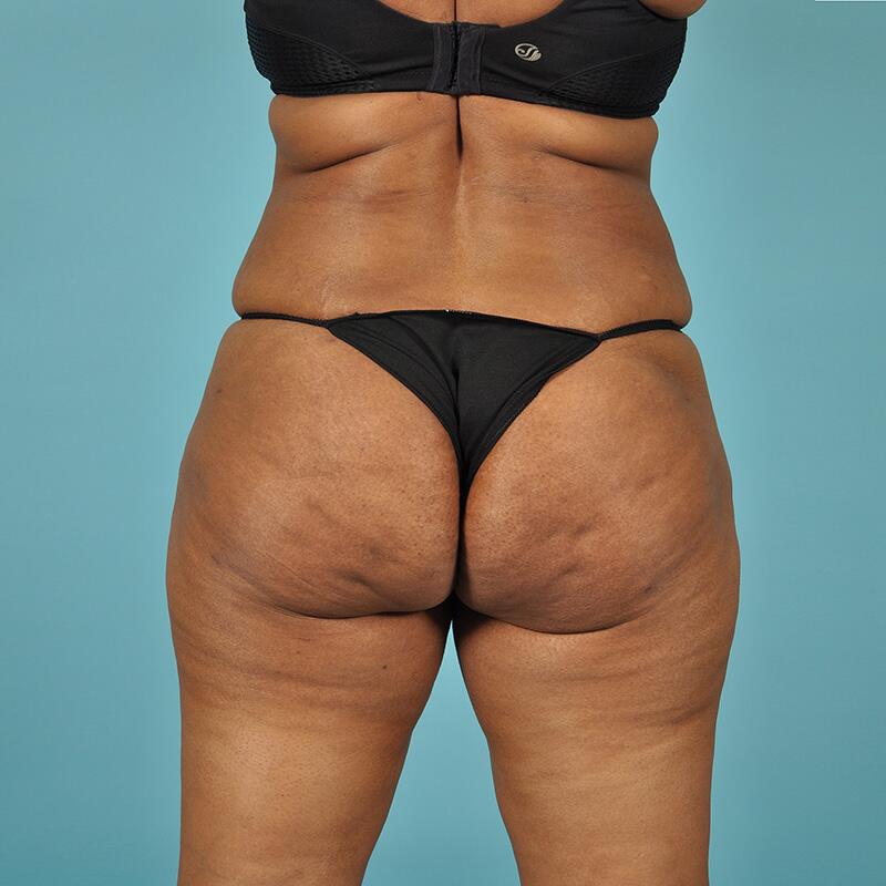 Liposuction Before & After Image