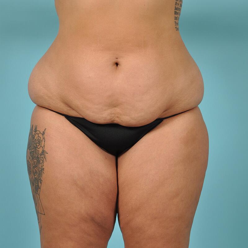 Liposuction Before & After Image