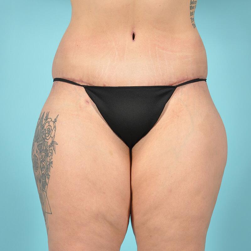 Liposuction Before & After Image