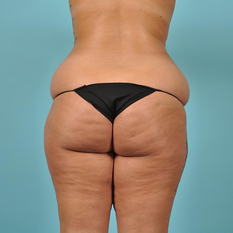 Liposuction Before & After Image Patient 27425