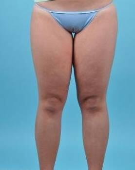 Liposuction Before & After Image