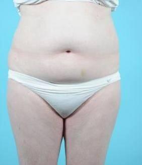 Liposuction Before & After Image