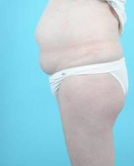 Liposuction Before & After Image