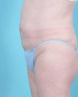 Liposuction Before & After Image